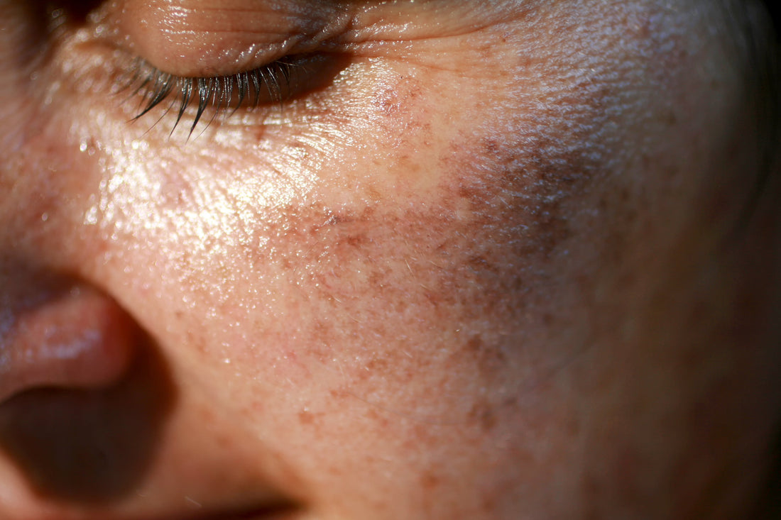 Pigmentation: The Full Story