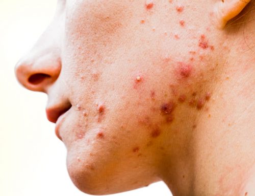 What you really need to know about Acne Treatments